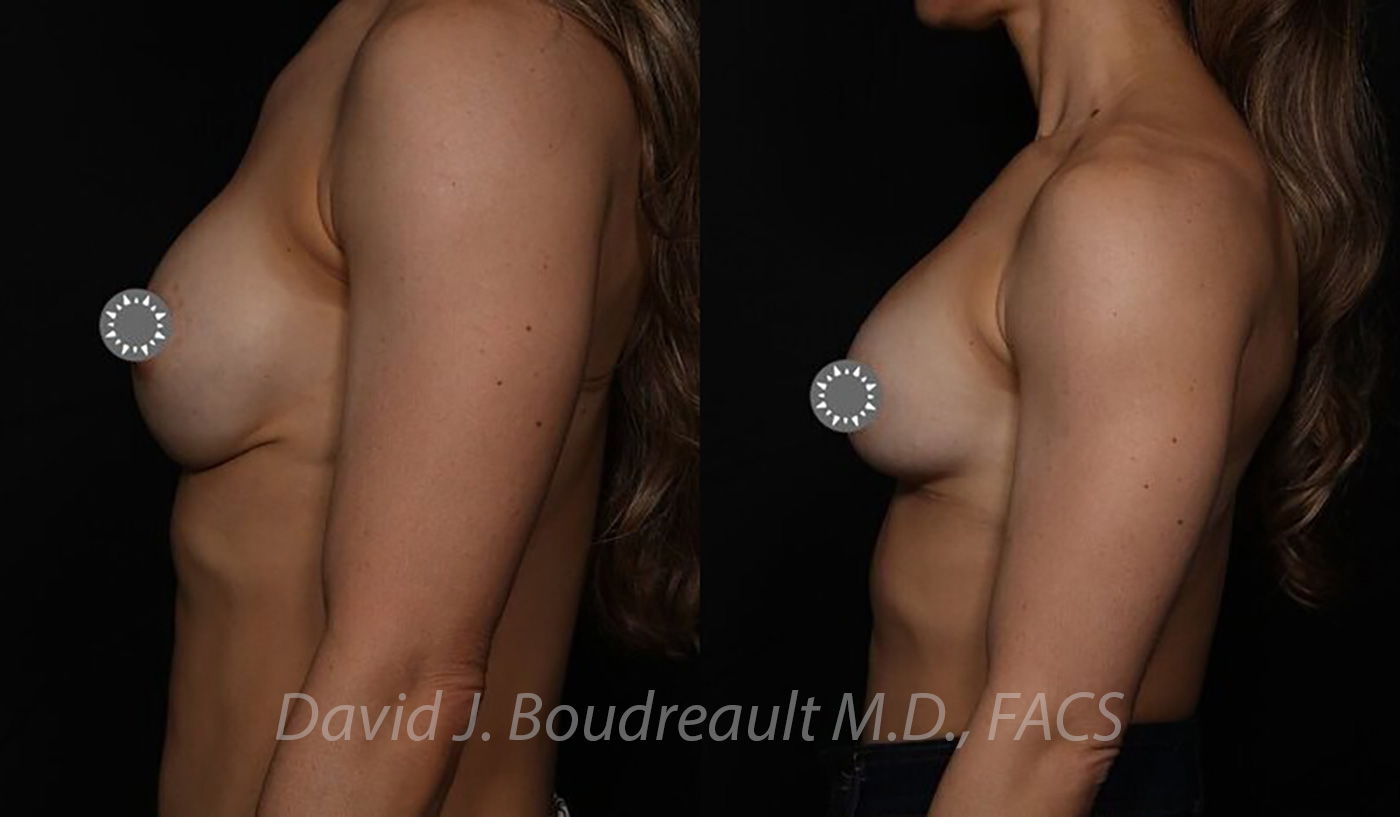 Breast Augmentation Before & After Image