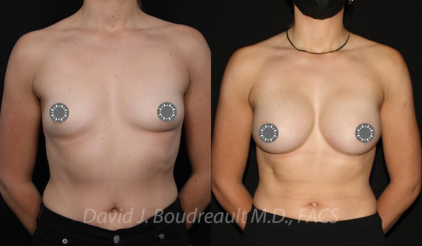 Breast Augmentation Before & After Image
