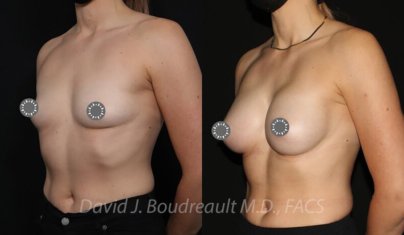 Breast Augmentation Before & After Image
