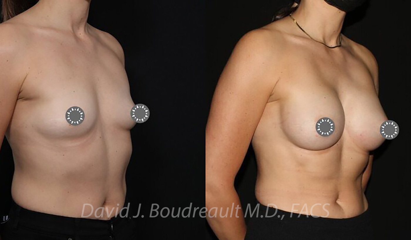 Breast Augmentation Before & After Image