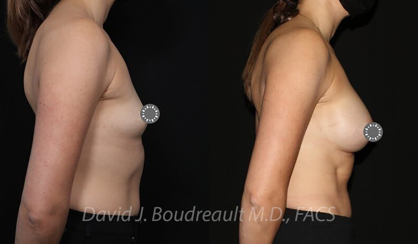 Breast Augmentation Before & After Image
