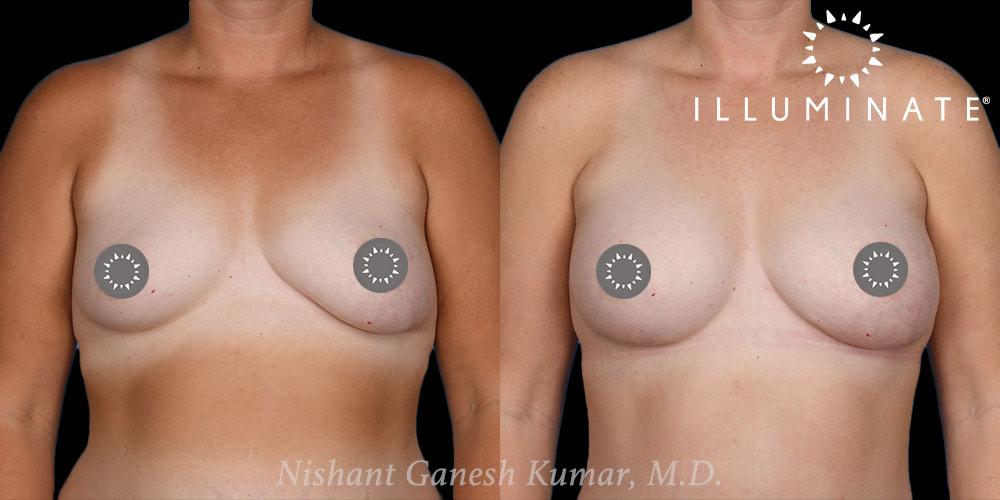 Breast Augmentation Before & After Image