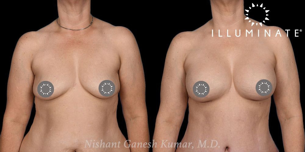 Breast Augmentation Before & After Image