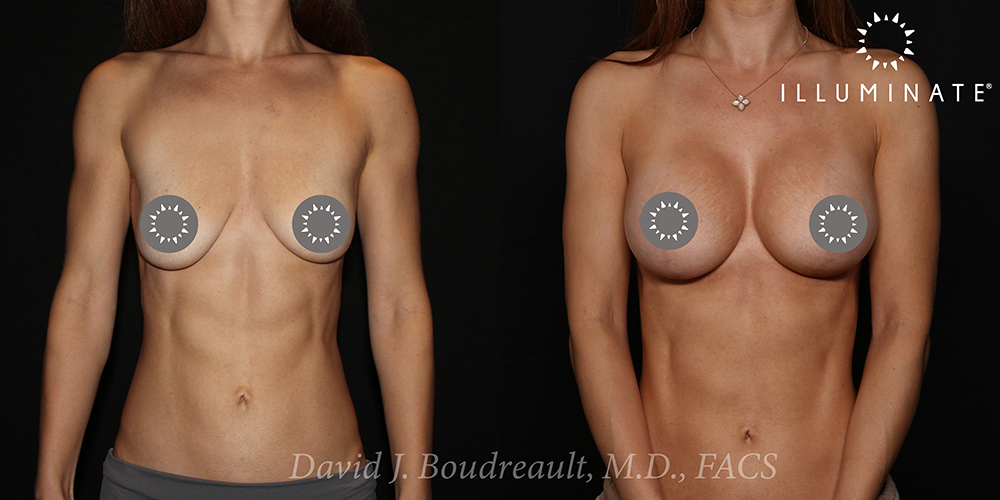 Breast Augmentation Before & After Image
