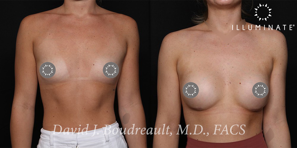 Breast Augmentation Before & After Image