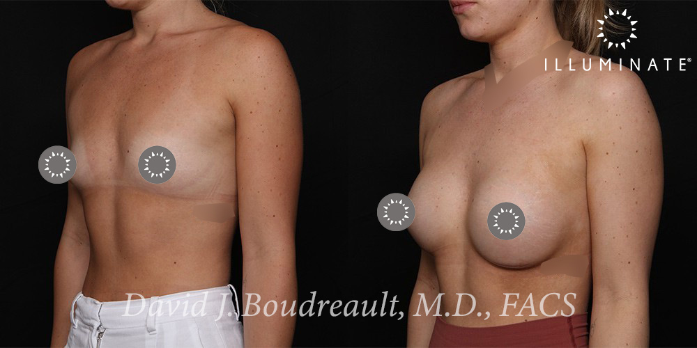 Breast Augmentation Before & After Image