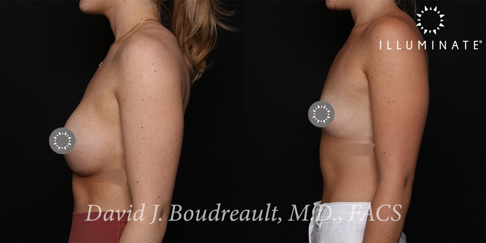 Breast Augmentation Before & After Image