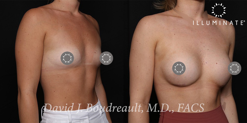 Breast Augmentation Before & After Image