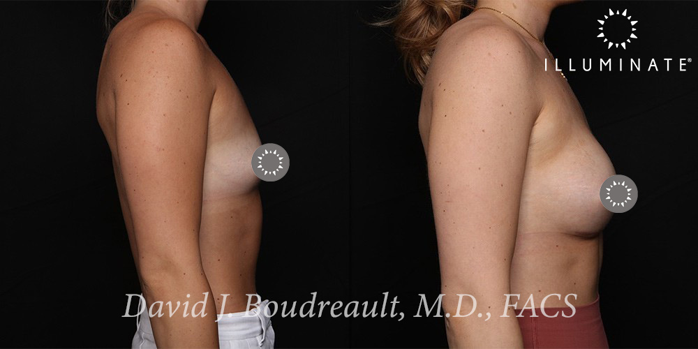 Breast Augmentation Before & After Image