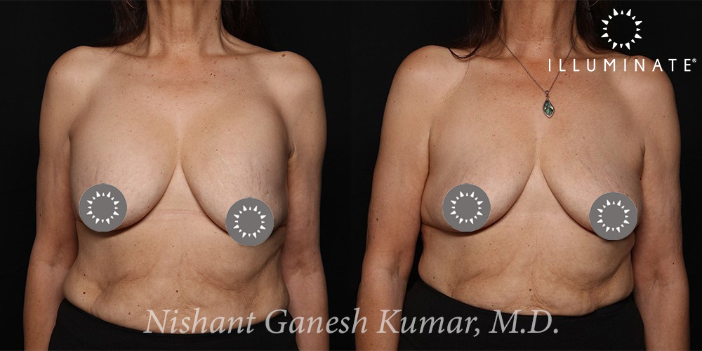 Breast Implant Removal Before & After Image
