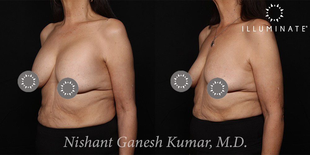 Breast Implant Removal Before & After Image