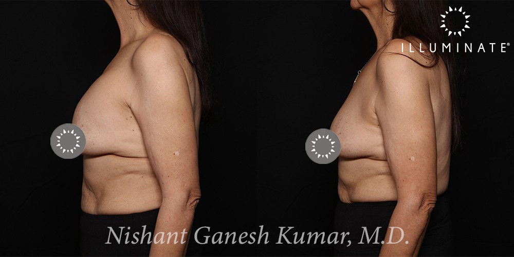 Breast Implant Removal Before & After Image