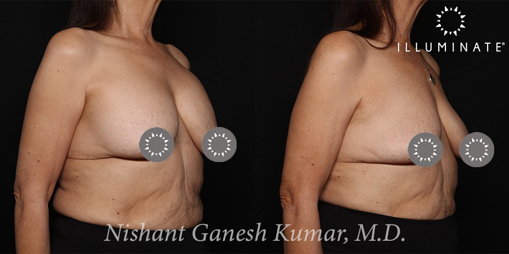 Breast Implant Removal Before & After Image