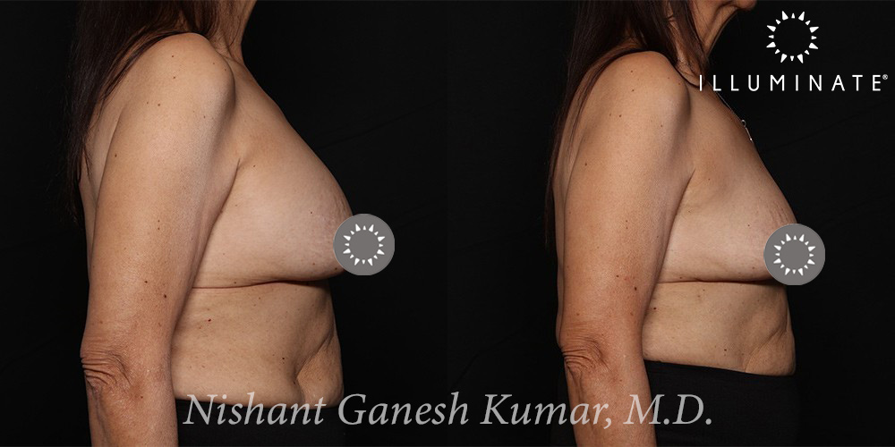 Breast Implant Removal Before & After Image