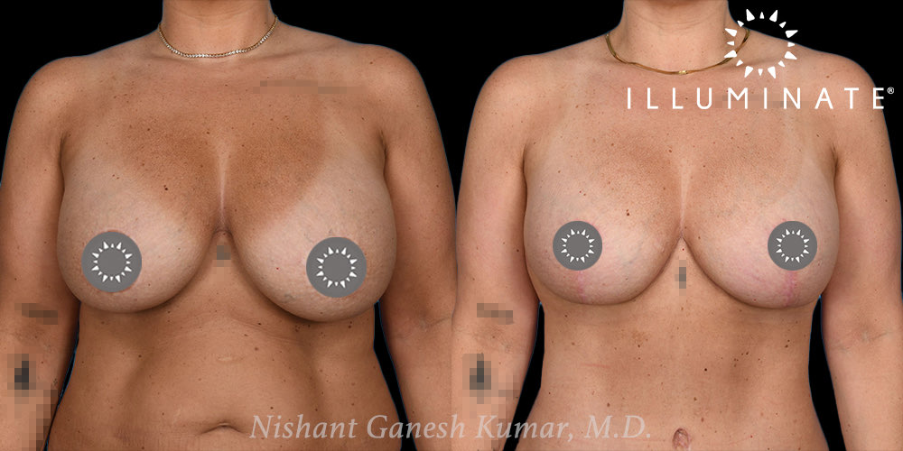 Breast Lift With Implants Before & After Image