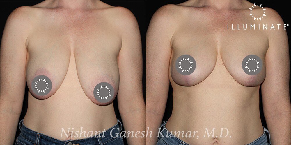 Breast Reduction  Before & After Image