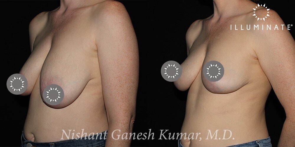 Breast Reduction  Before & After Image
