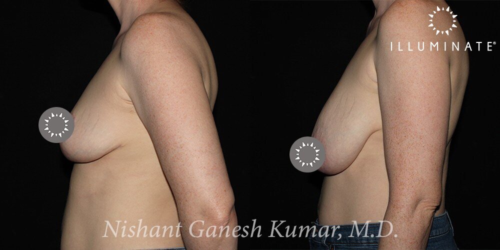 Breast Reduction  Before & After Image