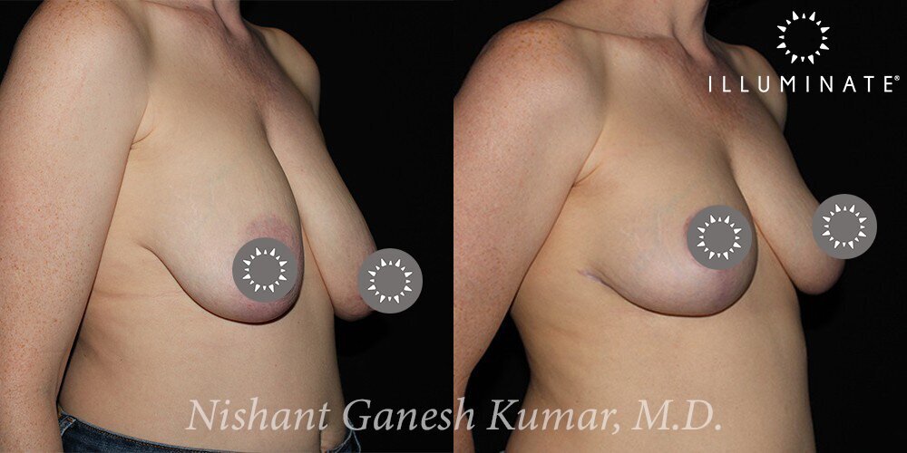 Breast Reduction  Before & After Image