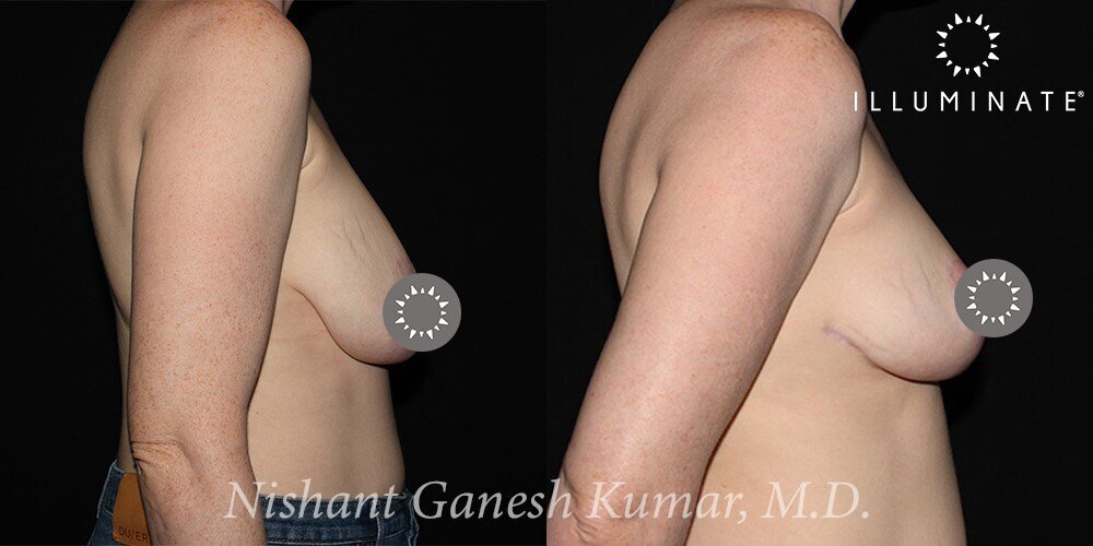 Breast Reduction  Before & After Image