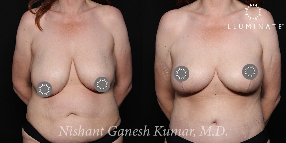 Breast Reduction  Before & After Image