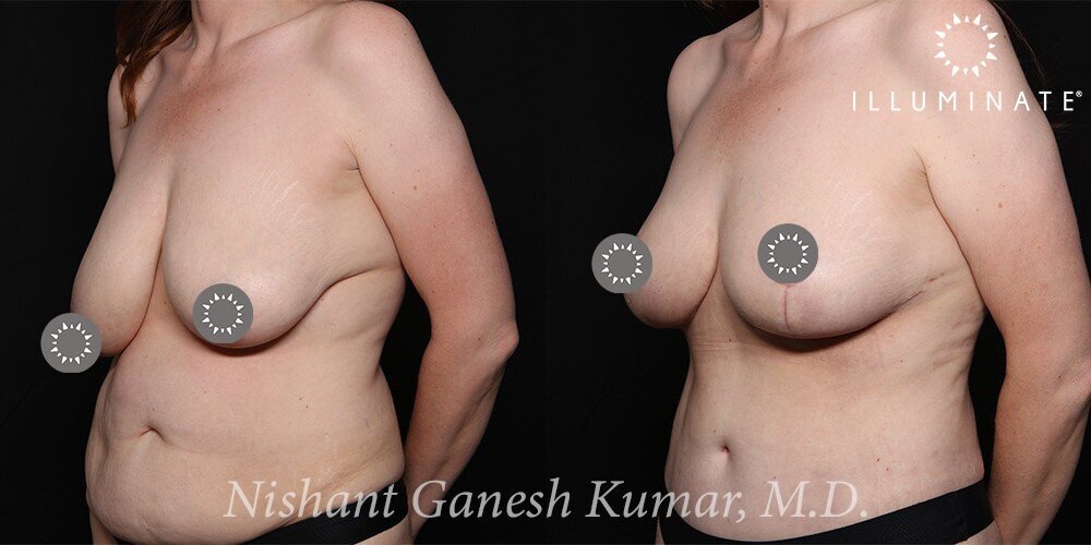 Breast Reduction  Before & After Image