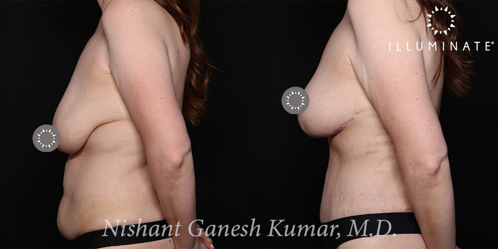 Breast Reduction  Before & After Image