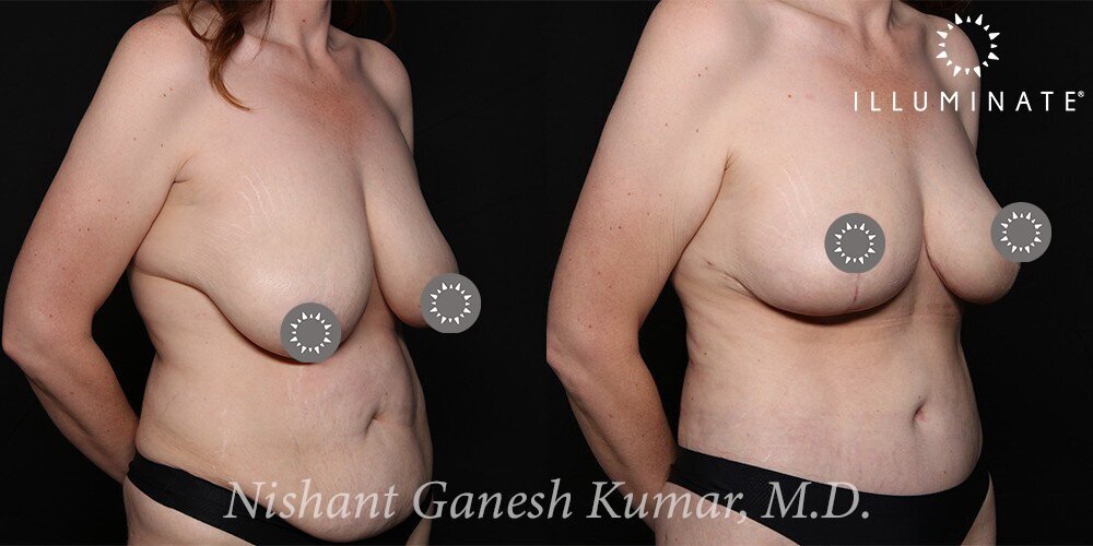 Breast Reduction  Before & After Image