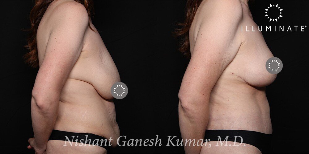 Breast Reduction  Before & After Image