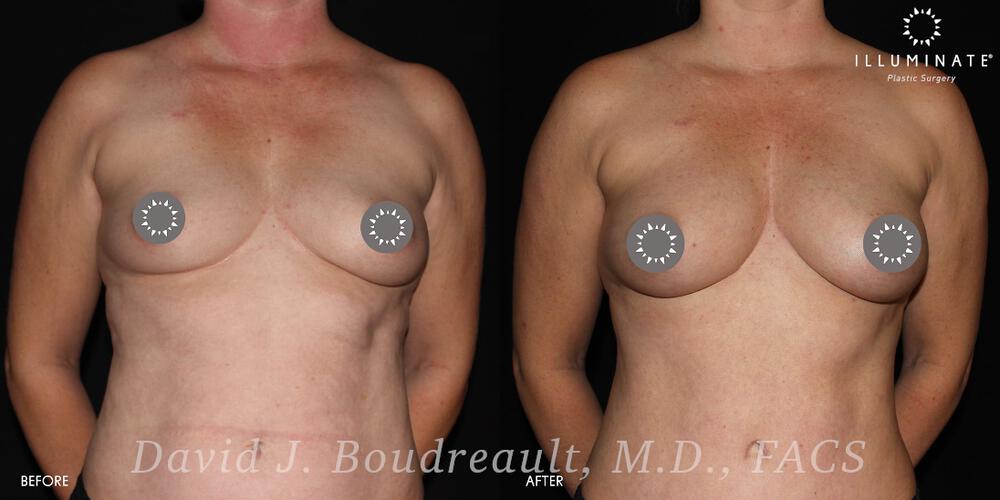 Fat Transfer Breast  Before & After Image
