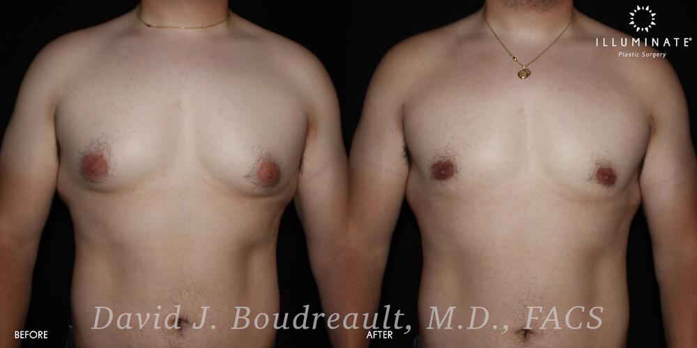 Male Breast Reduction  Before & After Image