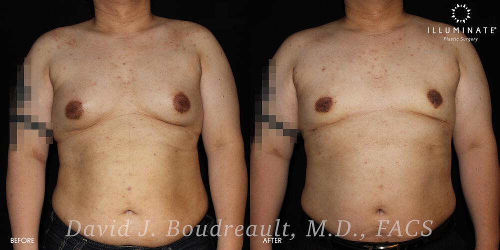 Male Breast Reduction  Before & After Image