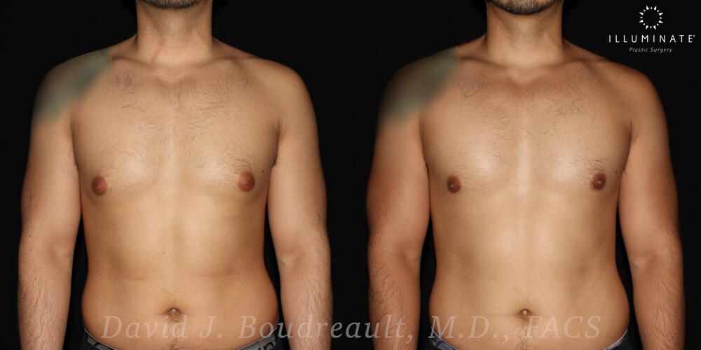 Male Breast Reduction  Before & After Image
