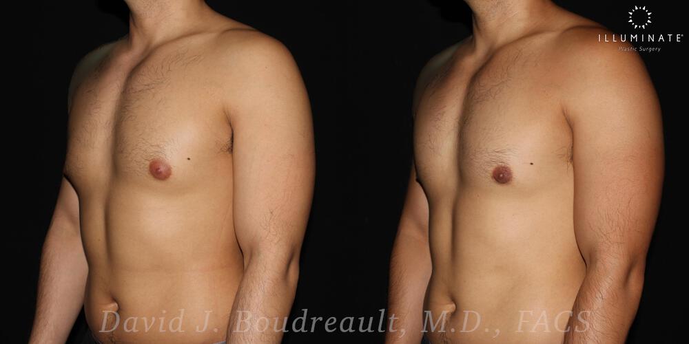 Male Breast Reduction  Before & After Image