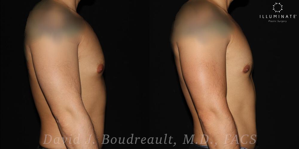 Male Breast Reduction  Before & After Image