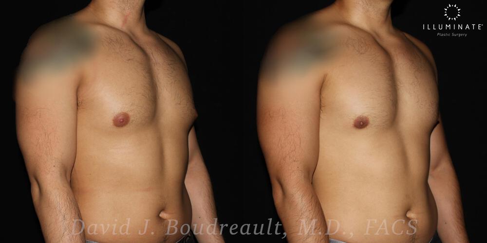 Male Breast Reduction  Before & After Image