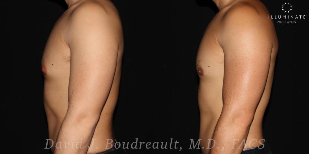 Male Breast Reduction  Before & After Image