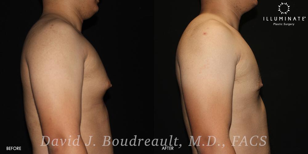 Male Breast Reduction  Before & After Image