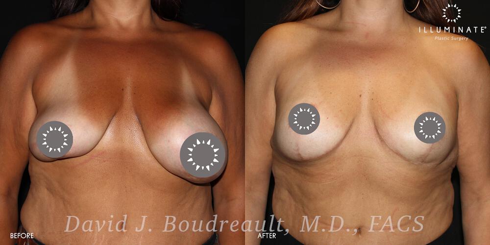 Mastopexy Before & After Image