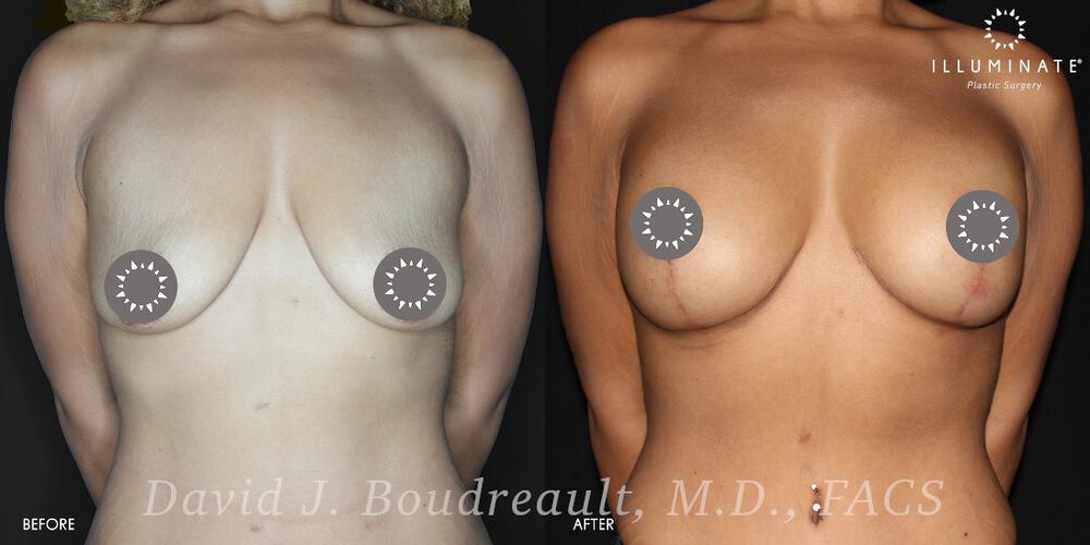 Mastopexy Before & After Image