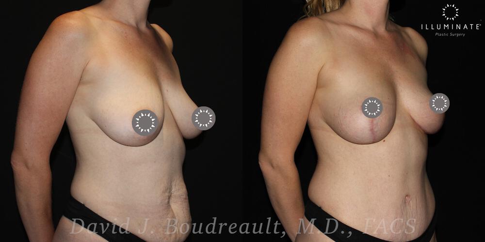 Mastopexy Before & After Image