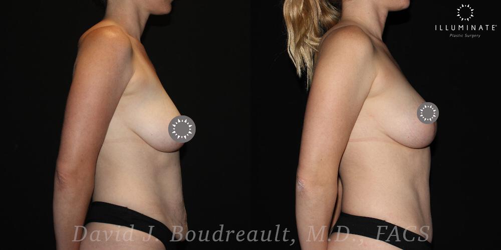 Mastopexy Before & After Image