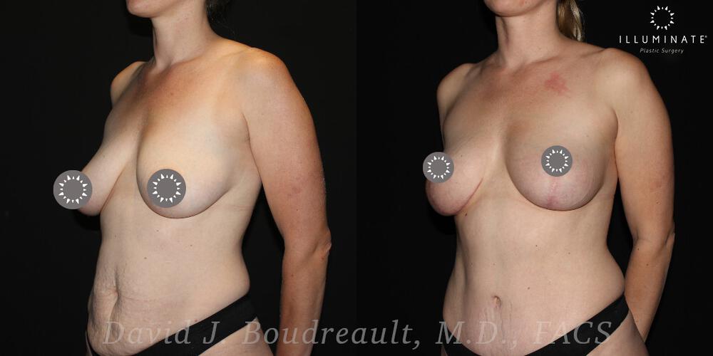 Mastopexy Before & After Image