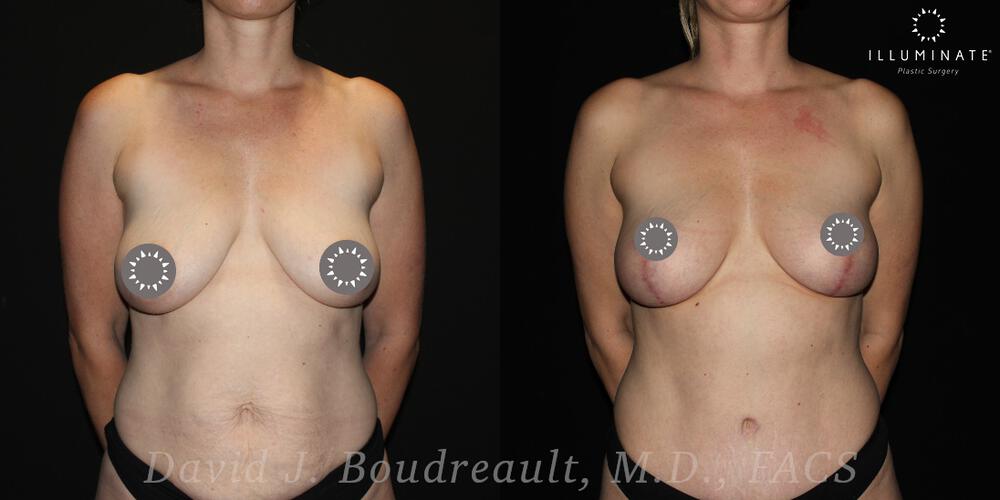 Mastopexy Before & After Image