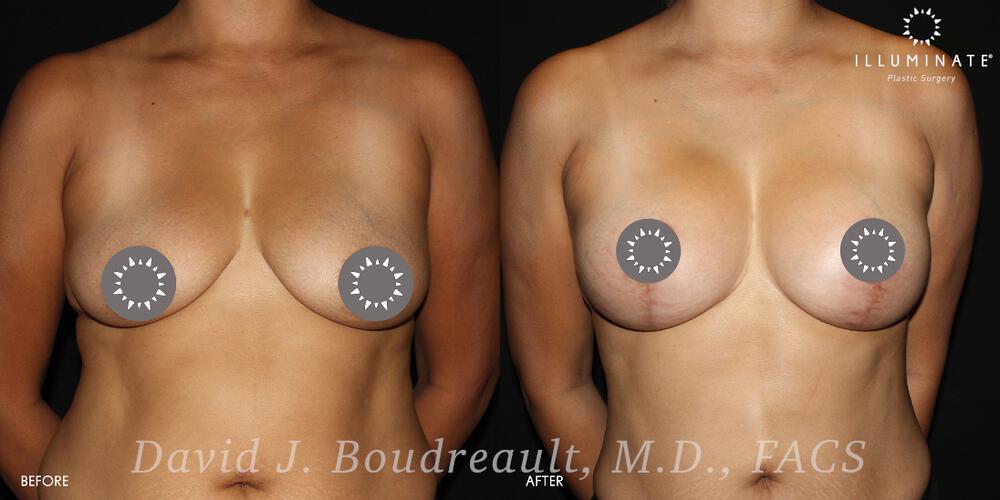 Mastopexy Before & After Image