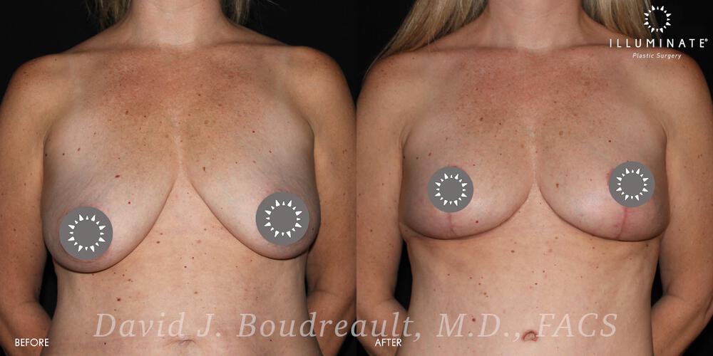 Mastopexy Before & After Image