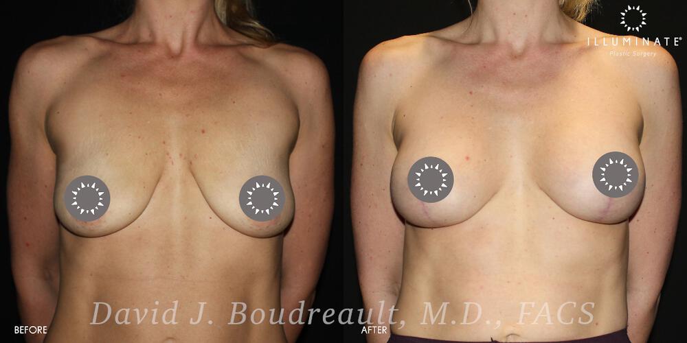 Mastopexy Before & After Image