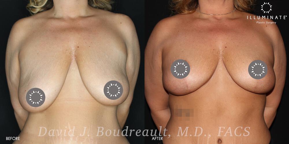 Mastopexy Before & After Image