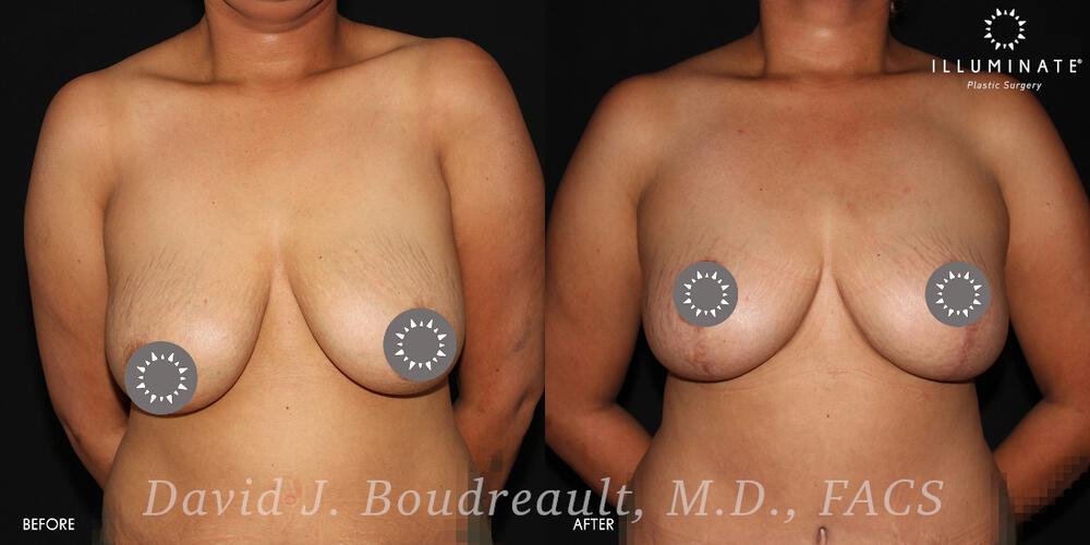 Mastopexy Before & After Image