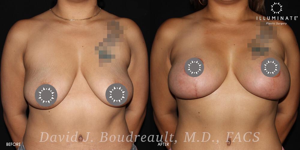 Mastopexy Before & After Image